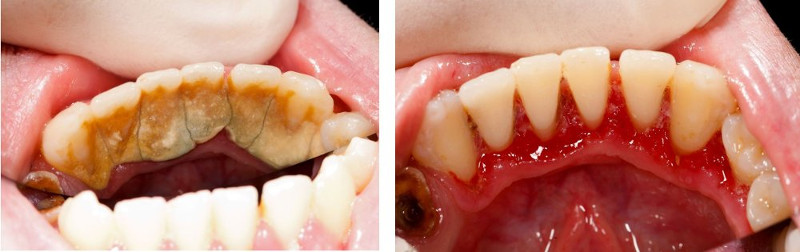 Массивный зубной налет до и после